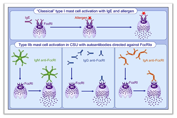 chronic spontaneous urticaria