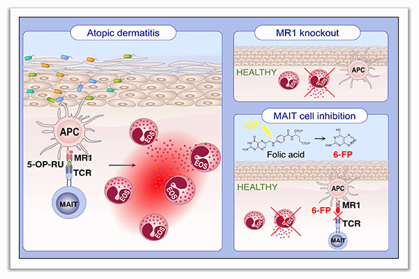 atopic dermatitis