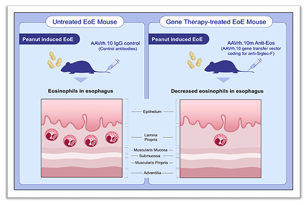 eosinophilic esophagitis